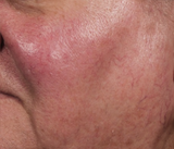 How the excel®V+ laser treats spider veins & other skin concerns