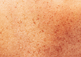 How to Treat Post Summer Pigmentation and Sun Damage Safely