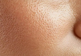 Professional skin treatment for uneven texture and enlarged pores