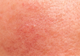 Rosacea and diffused redness on cheeks showing sensitive skin condition