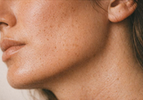 Post summer skin recovery treatment at Vitality Laser Skin Geelong