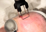 CO2 Laser Explained: CoolPeel vs DOT Therapy and Which Is Right for You