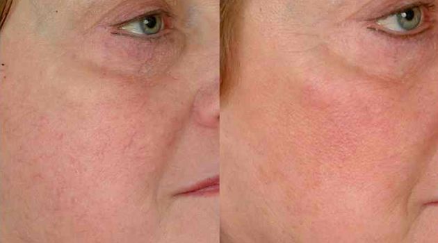 Laser Pigmentation Removal Geelong