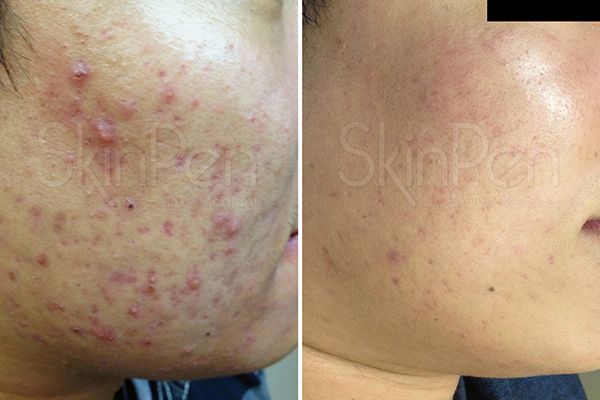 skin needling Melbourne SkinPen vs DermaPen