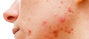 Acne Skin Concerns Vitality Geelong 1