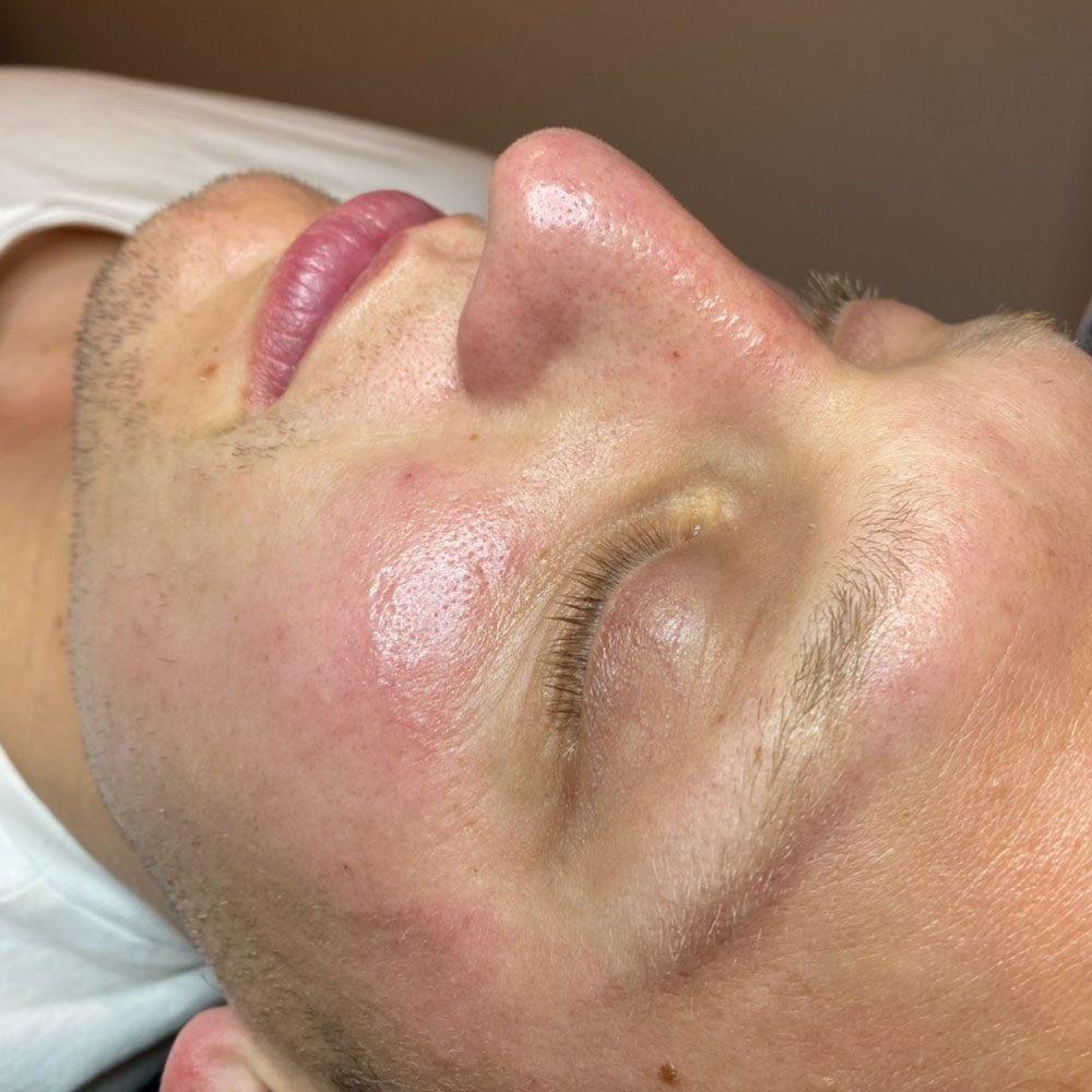 hydrafacial before and after